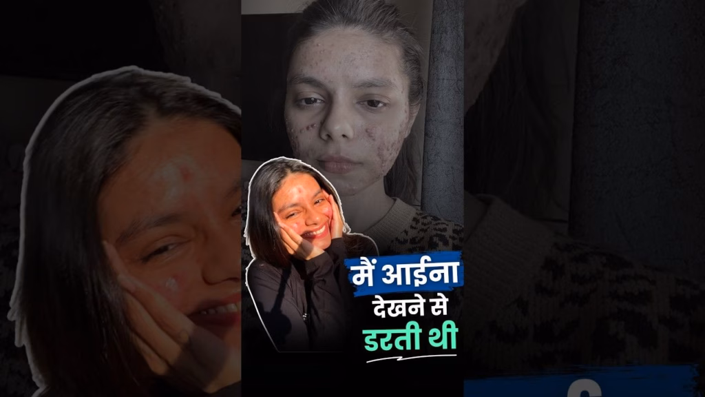 Acne ने मेरा Confidence तोड़ा, तो मैंने खूबसूरती के मायने ही बदल दिए। | The Better India Hindi